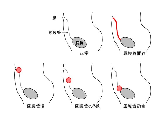 尿膜管遺残 筑波大学腎泌尿器外科診療グループ