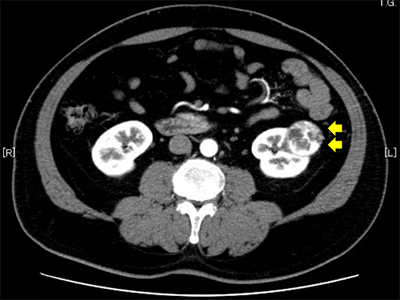 副腎がん患者の生存率に影響を与える要因は何ですか?