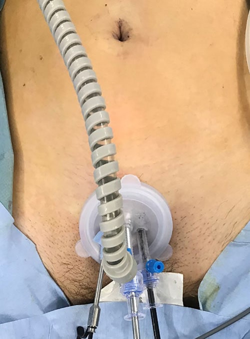 単孔式腹腔鏡下尿膜管摘除術